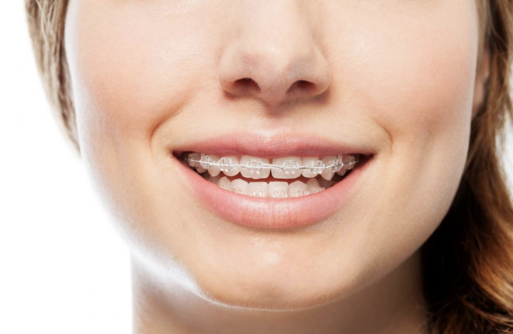 Alt text: Close-up of a smile with clear ceramic braces.